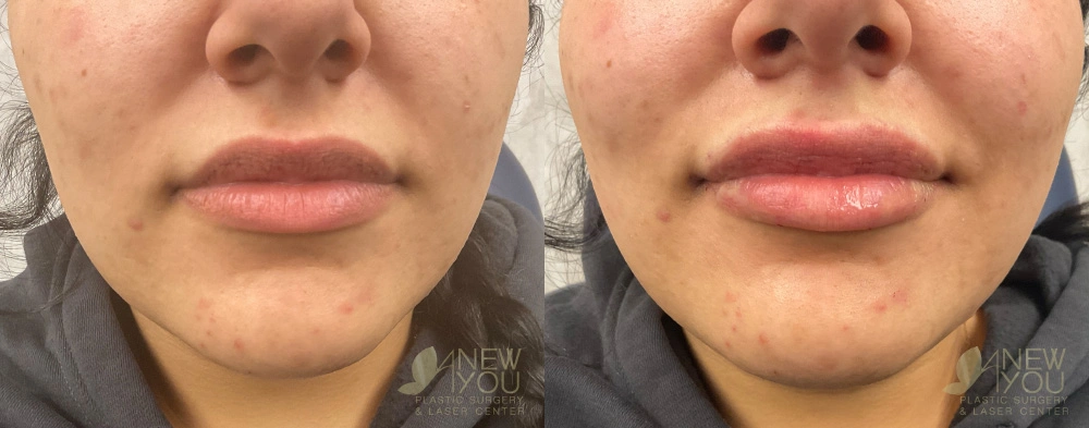 Real Patient Results by Dr. Shah of A New You Plastic Surgery & Medical Spa in Chicago, IL