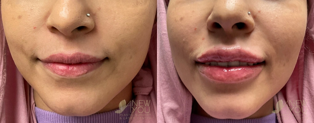 Real Patient Results by Dr. Shah of A New You Plastic Surgery & Medical Spa in Chicago, IL