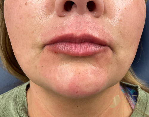 lip-augmentation-12a-before