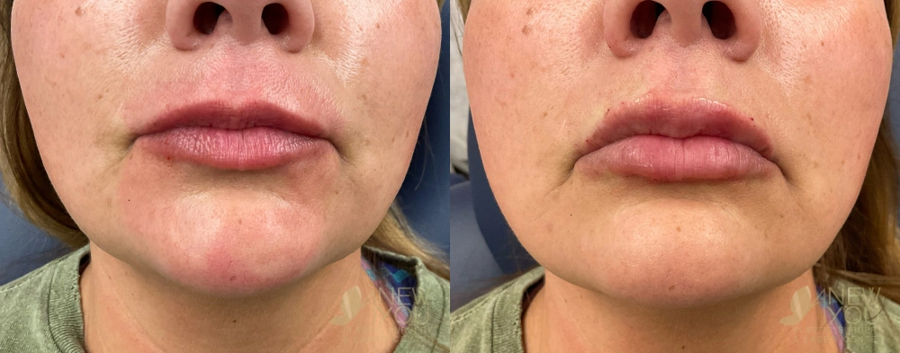 Real Patient Results by Dr. Shah of A New You Plastic Surgery & Medical Spa in Chicago, IL