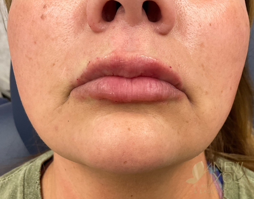 lip-augmentation-12a-post