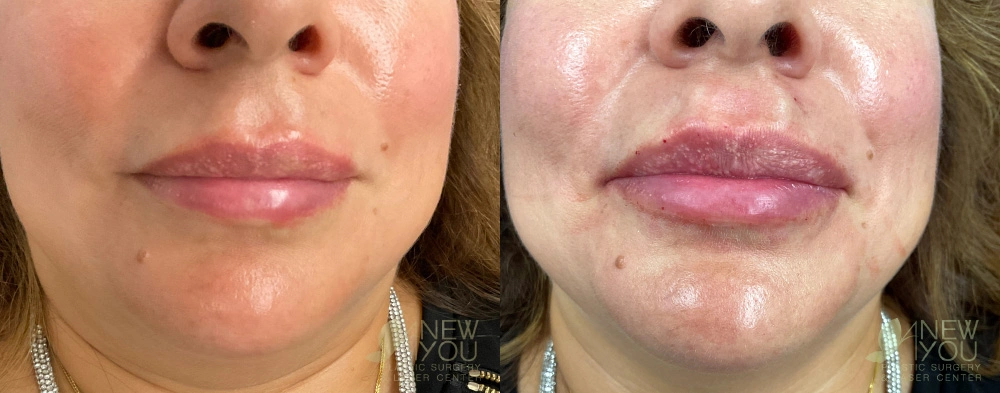 Real Patient Results by Dr. Shah of A New You Plastic Surgery & Medical Spa in Chicago, IL