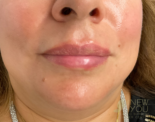 lip-augmentation-13a-before