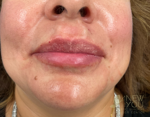 lip-augmentation-13a-post