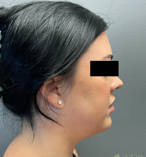 liposuction-17a-before