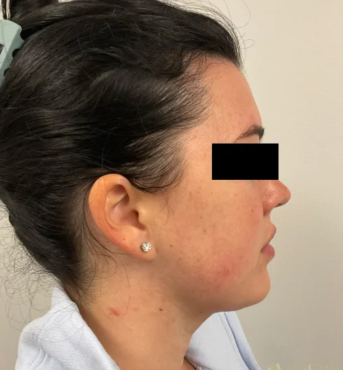 liposuction-17a-post