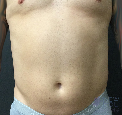 male-liposuction-04a-before