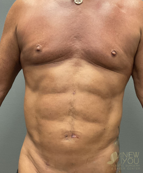 male-liposuction-05a-post