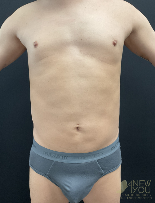 male-liposuction-07a-before