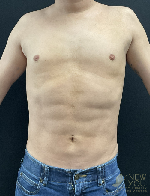 male-liposuction-07a-post