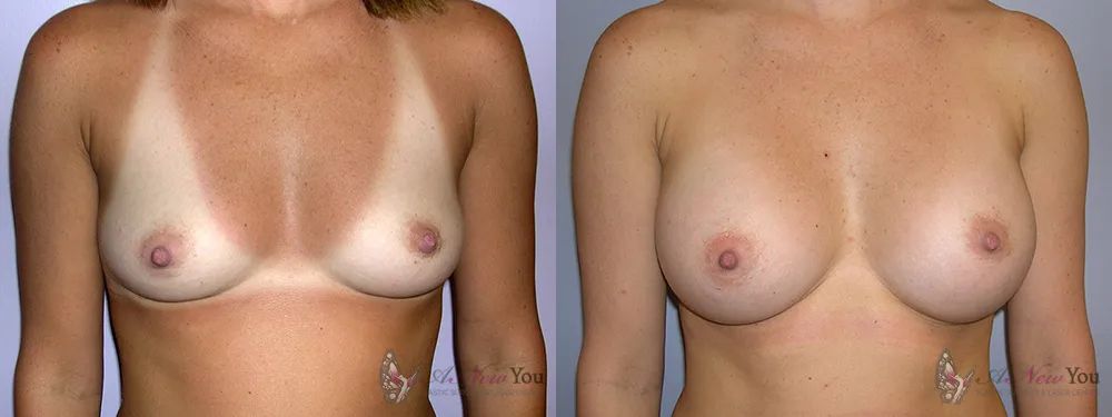 breast-augmentation-01a-ba1