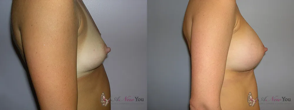 breast-augmentation-01a-ba2