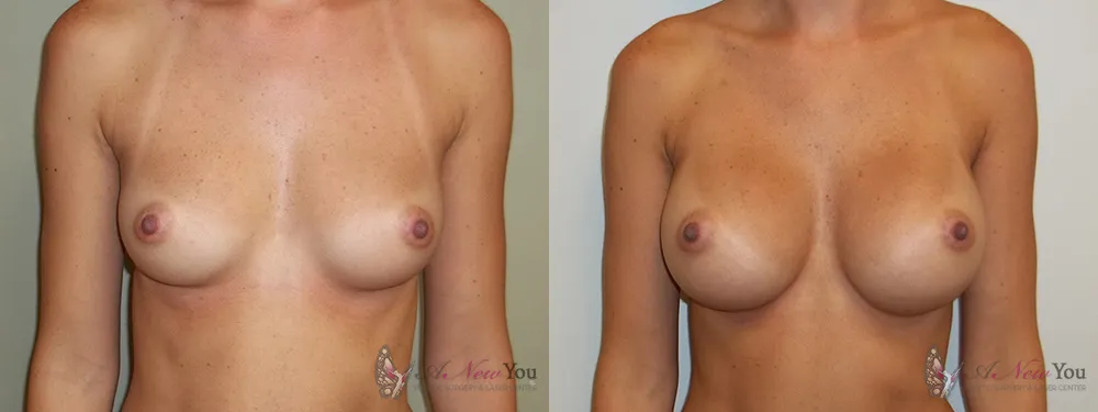breast-augmentation-02a-ba1