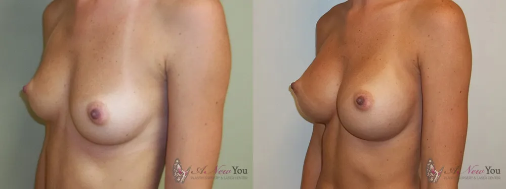 breast-augmentation-02a-ba2
