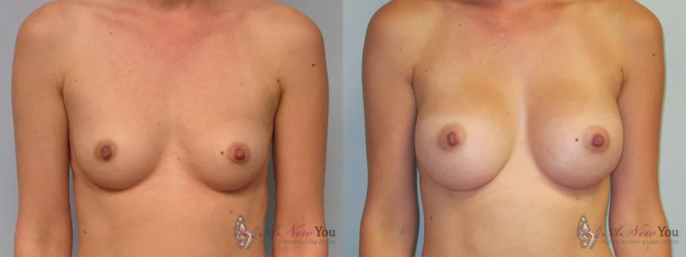 breast-augmentation-03a-ba1