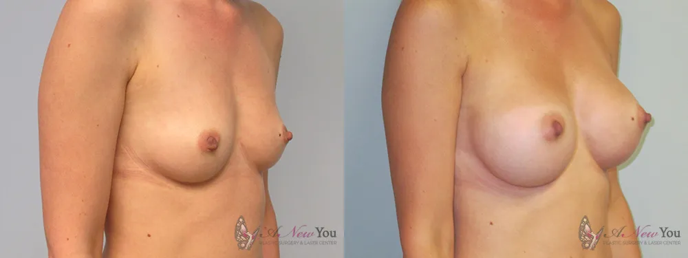 breast-augmentation-03a-ba2