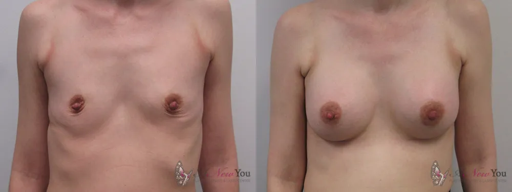 breast-augmentation-04a-ba1