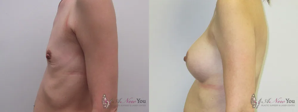 breast-augmentation-04a-ba2