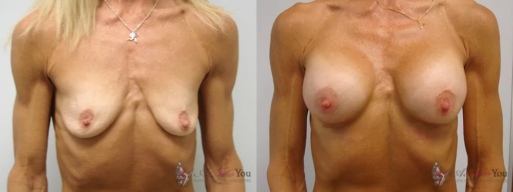 breast-augmentation-05a-ba1