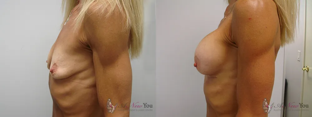 breast-augmentation-05a-ba2