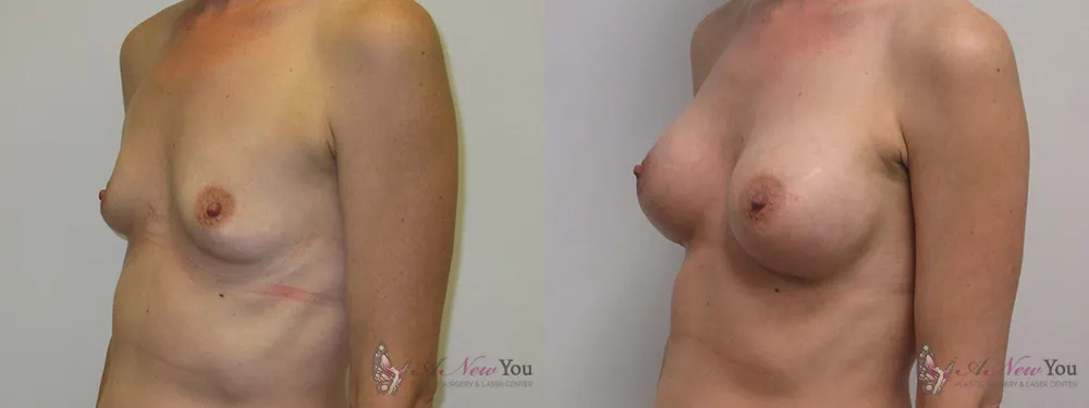 breast-augmentation-06a-ba2