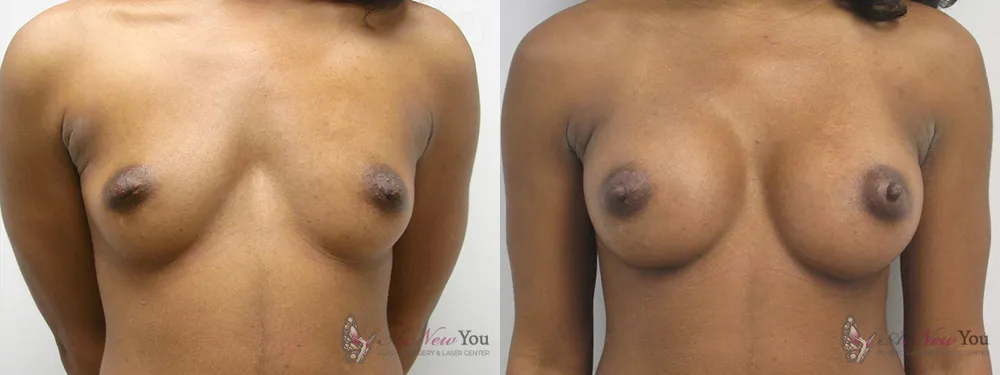 breast-augmentation-08a-ba1