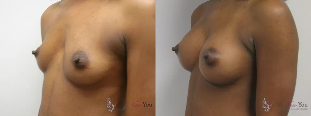 breast-augmentation-08a-ba2