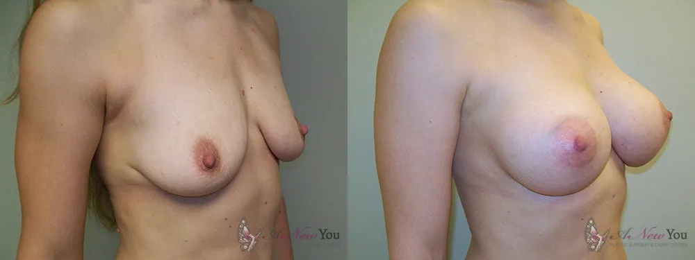 breast-augmentation-09a-ba2