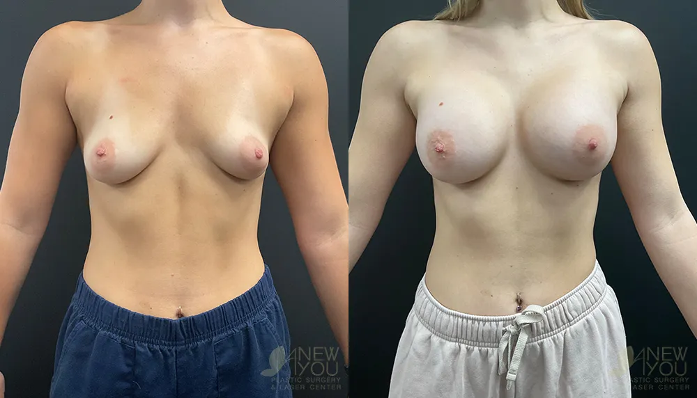 breast-augmentation-100a-ba1
