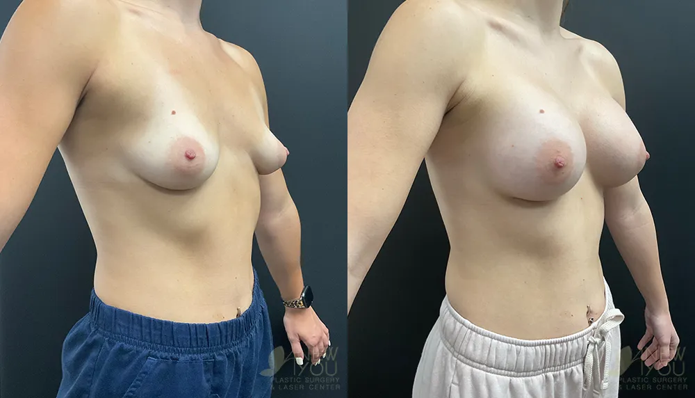 breast-augmentation-100a-ba2