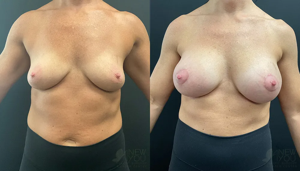 breast-augmentation-101a-ba1