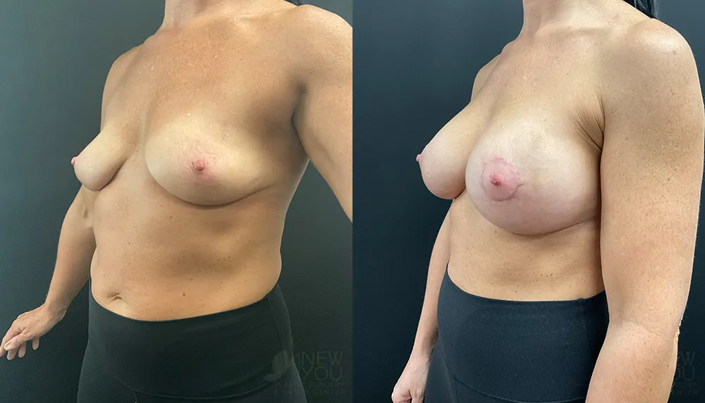 breast-augmentation-101a-ba2