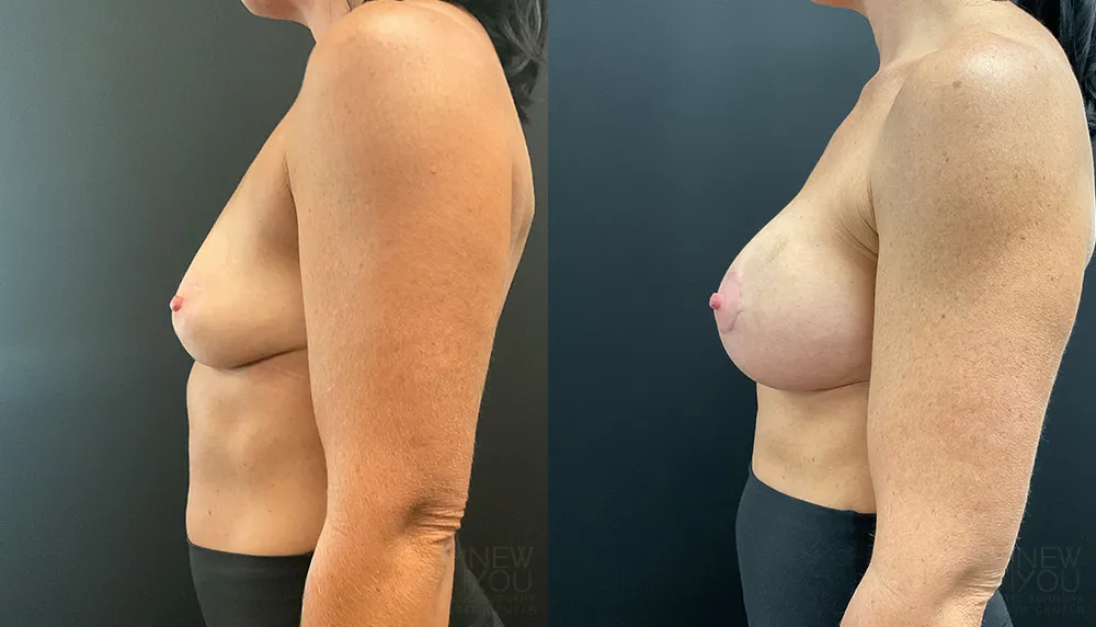 breast-augmentation-101a-ba3