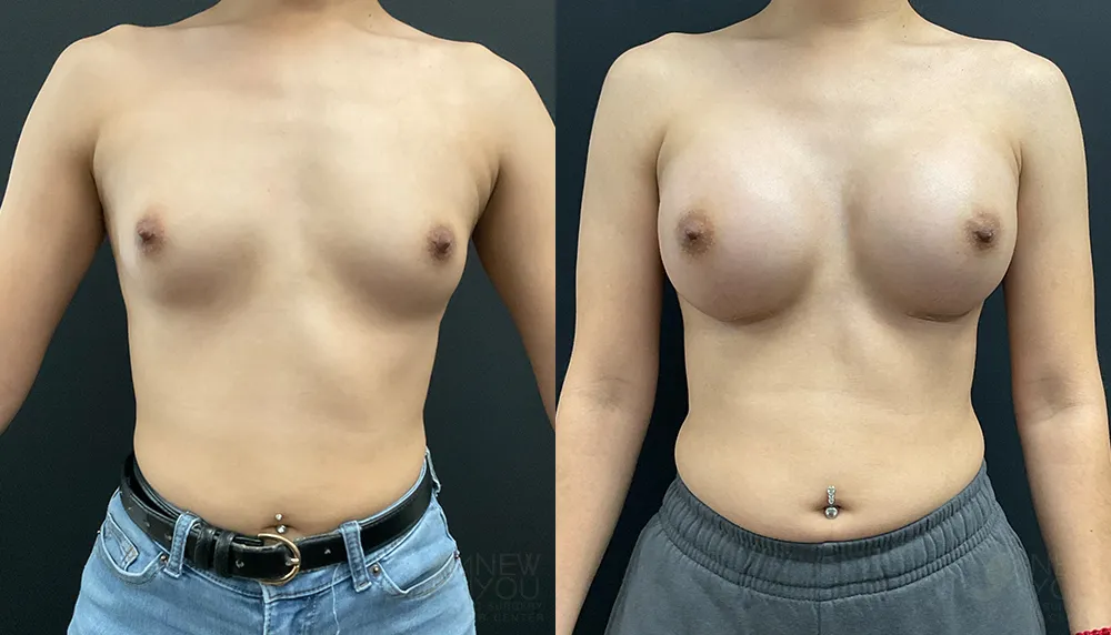 breast-augmentation-102a-ba1