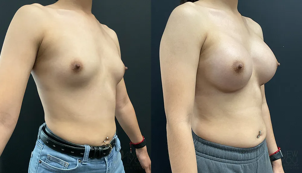 breast-augmentation-102a-ba2