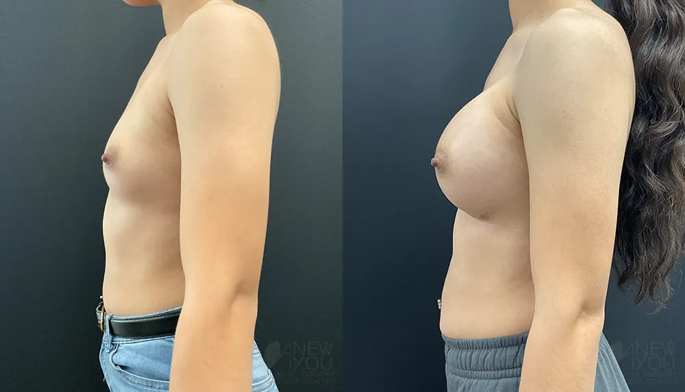 breast-augmentation-102a-ba3