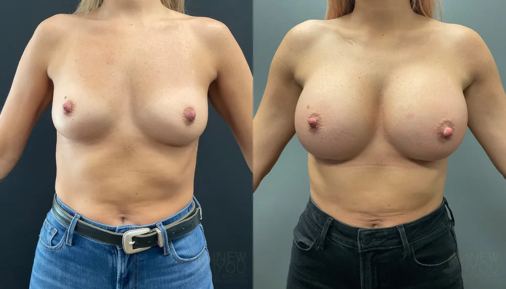 breast-augmentation-103a-ba1
