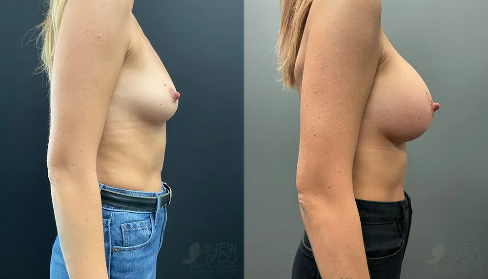 breast-augmentation-103a-ba3