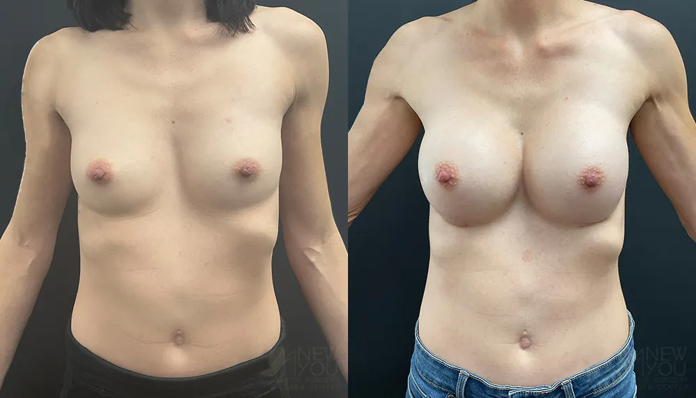 breast-augmentation-104a-ba1