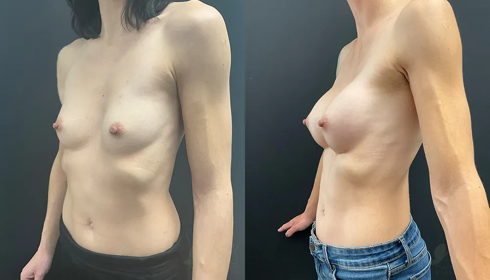 breast-augmentation-104a-ba2