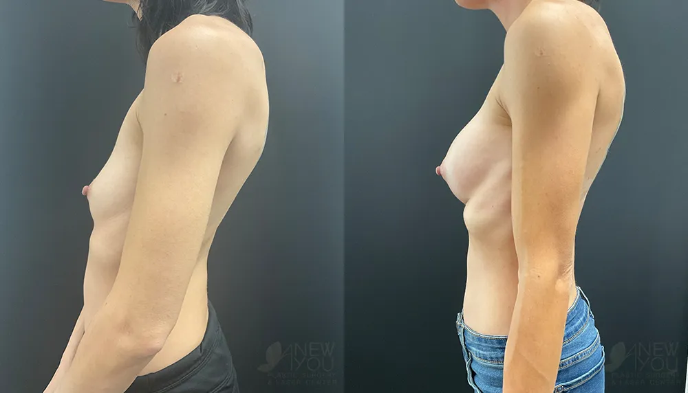 breast-augmentation-104a-ba3webp