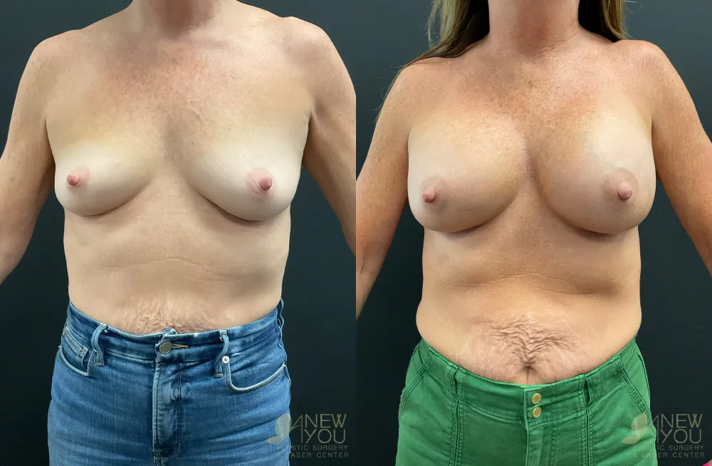 breast-augmentation-105a-ba1
