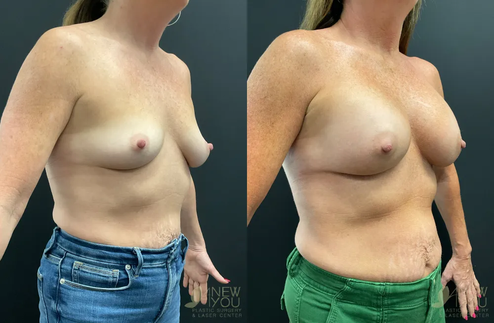 breast-augmentation-105a-ba2