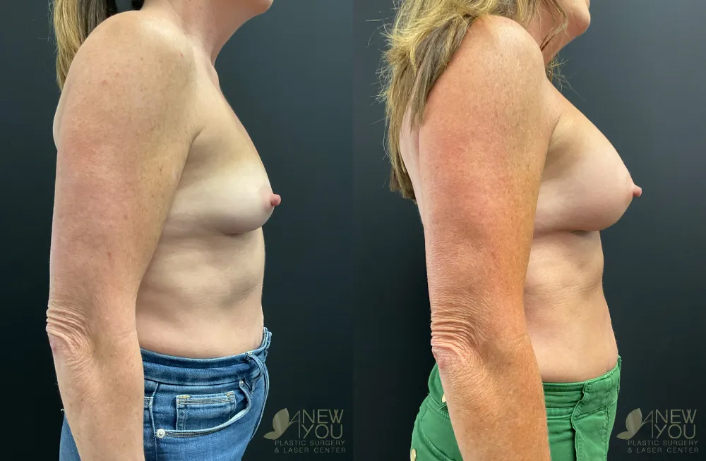 breast-augmentation-105a-ba3