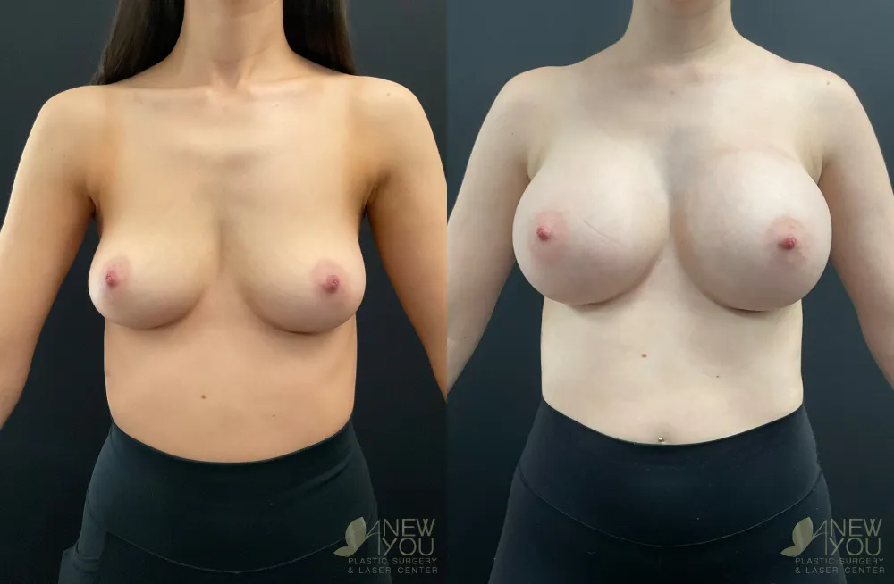 breast-augmentation-106a-ba1