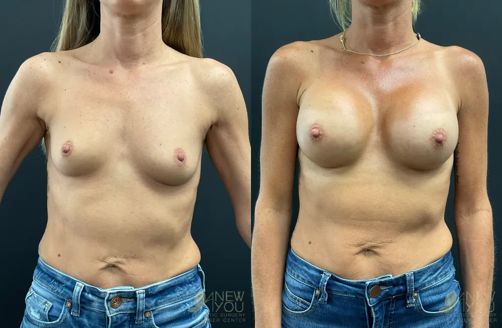 breast-augmentation-108a-ba1