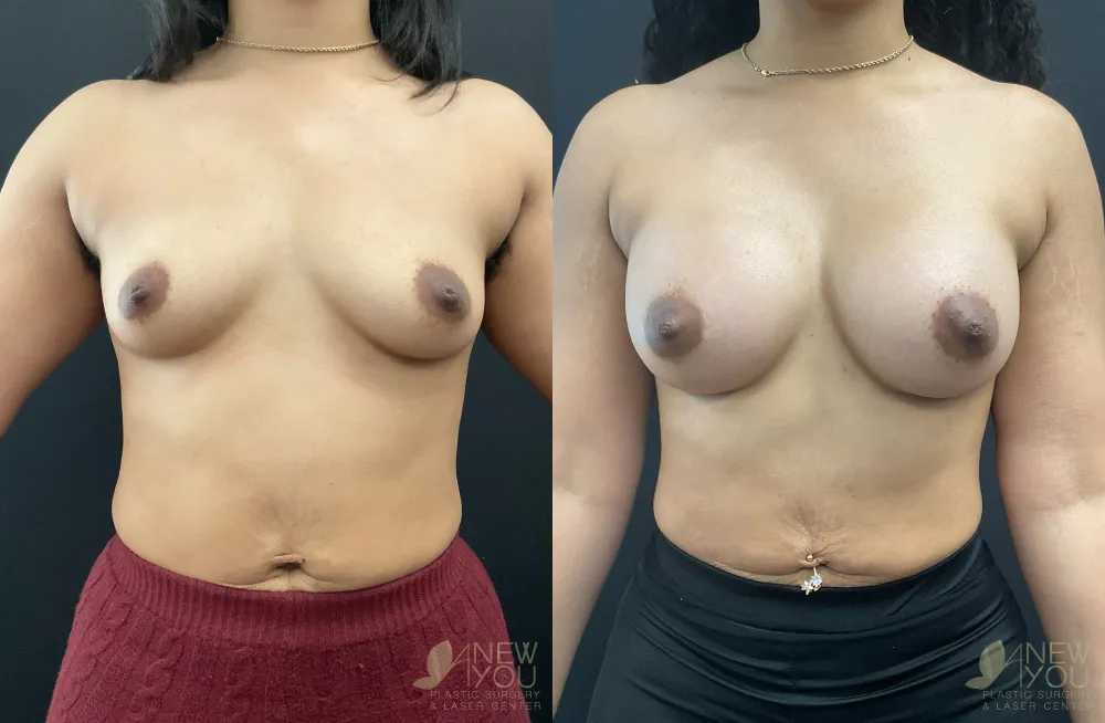 breast-augmentation-108a-ba1
