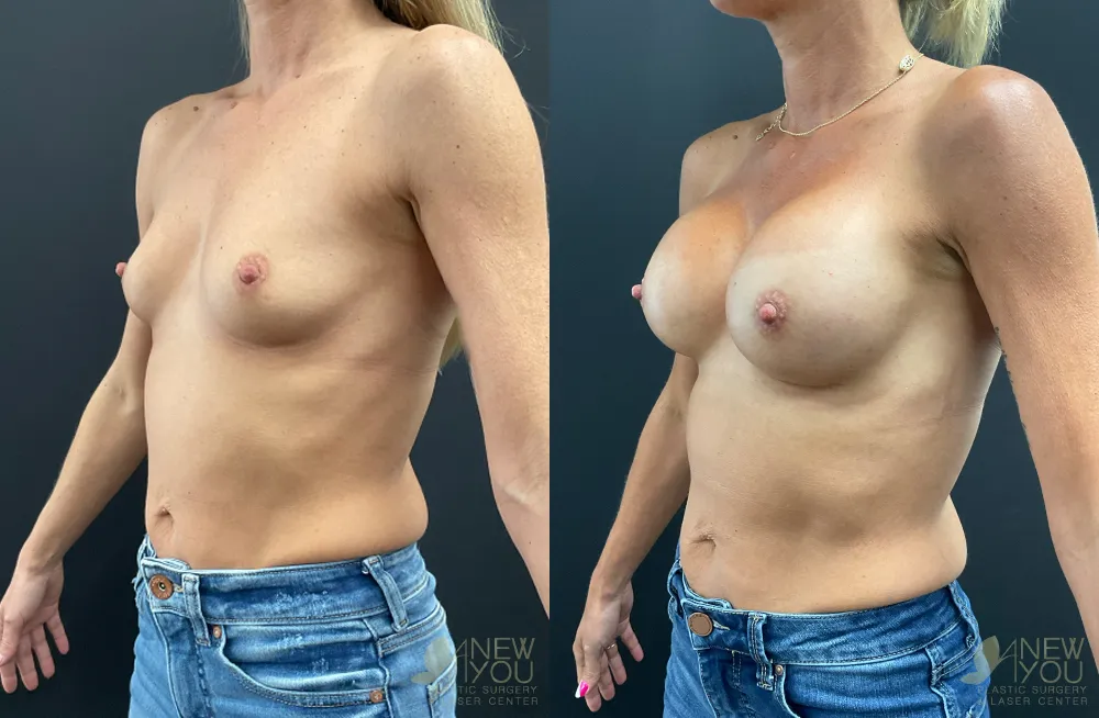 breast-augmentation-108a-ba2