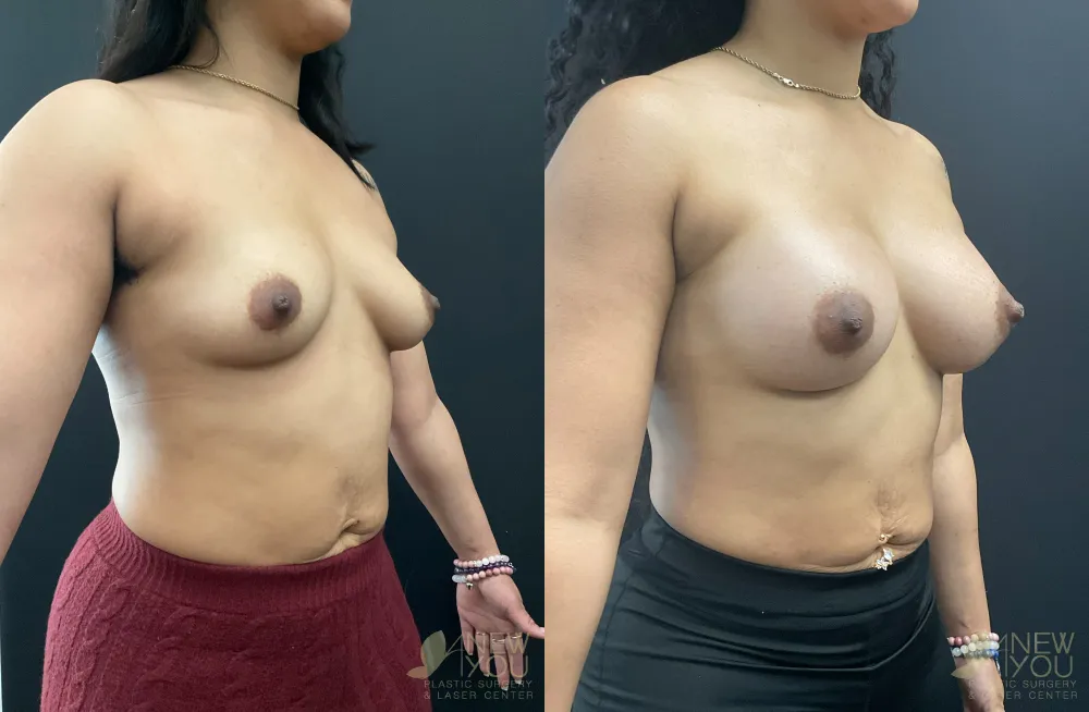 breast-augmentation-108a-ba2