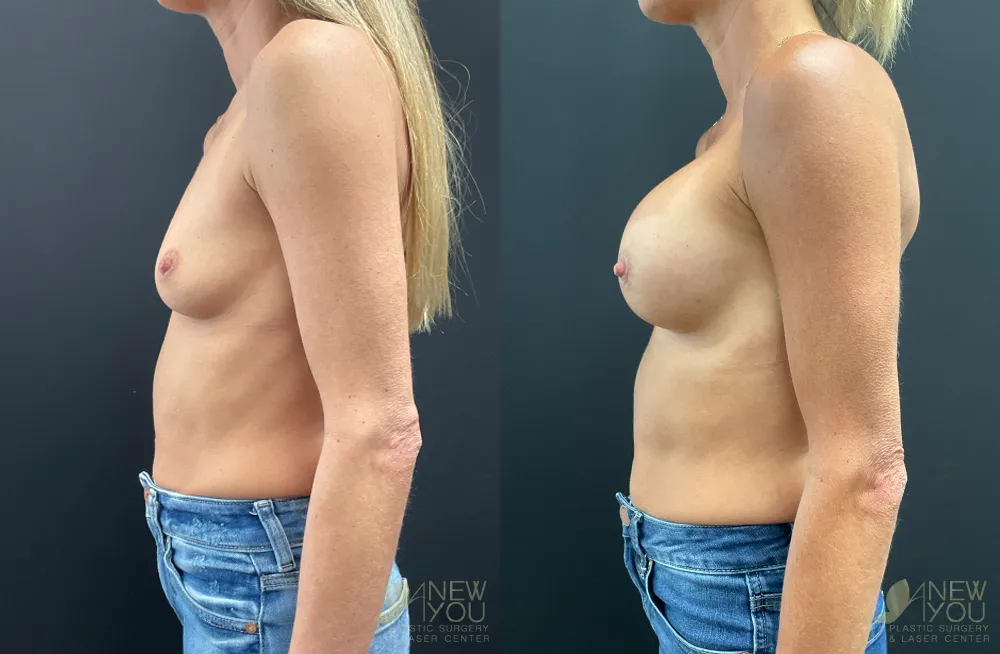 breast-augmentation-108a-ba3